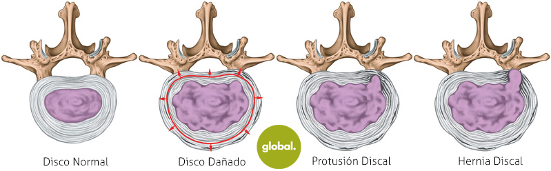 diferencia disco herniado y protusion
